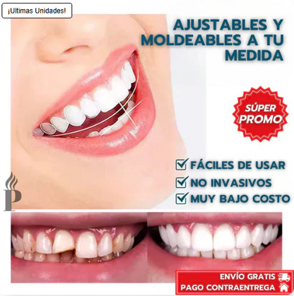 Carillas Instant Smile™: ocultan manchas, espacios y torceduras en minutos, desde casa