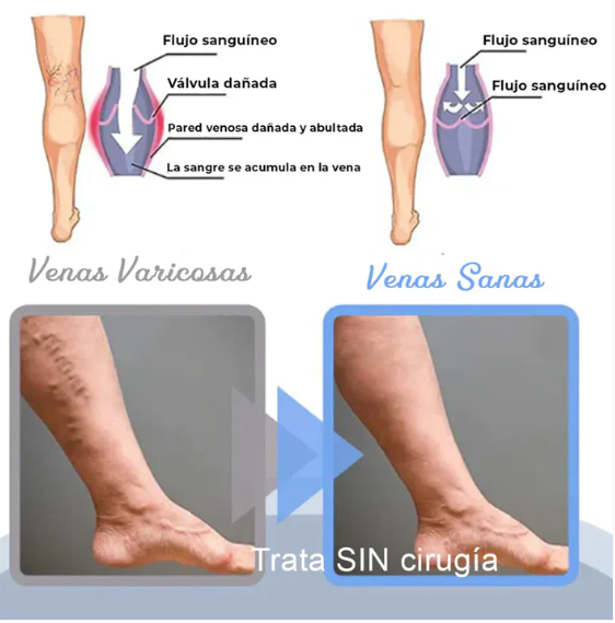 Piernas sin várices en 4 semanas, Spray + 12 Parches Gratis